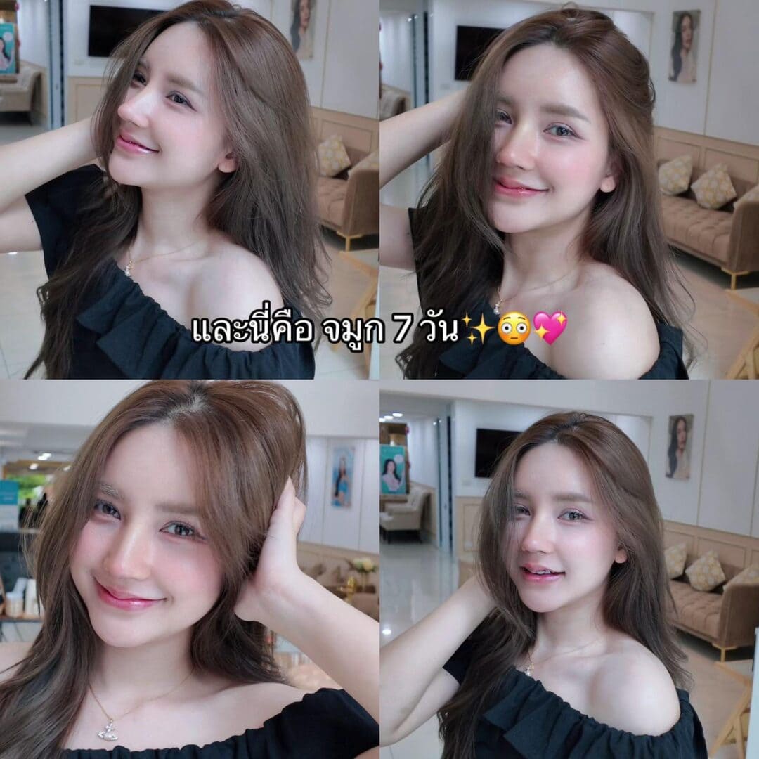 Balanced Nose Line ปรับรูจมูกให้ดูรับกับใบหน้ามากขึ้น 11 แก้จมูก หมอบิ๊ก s45 clinic