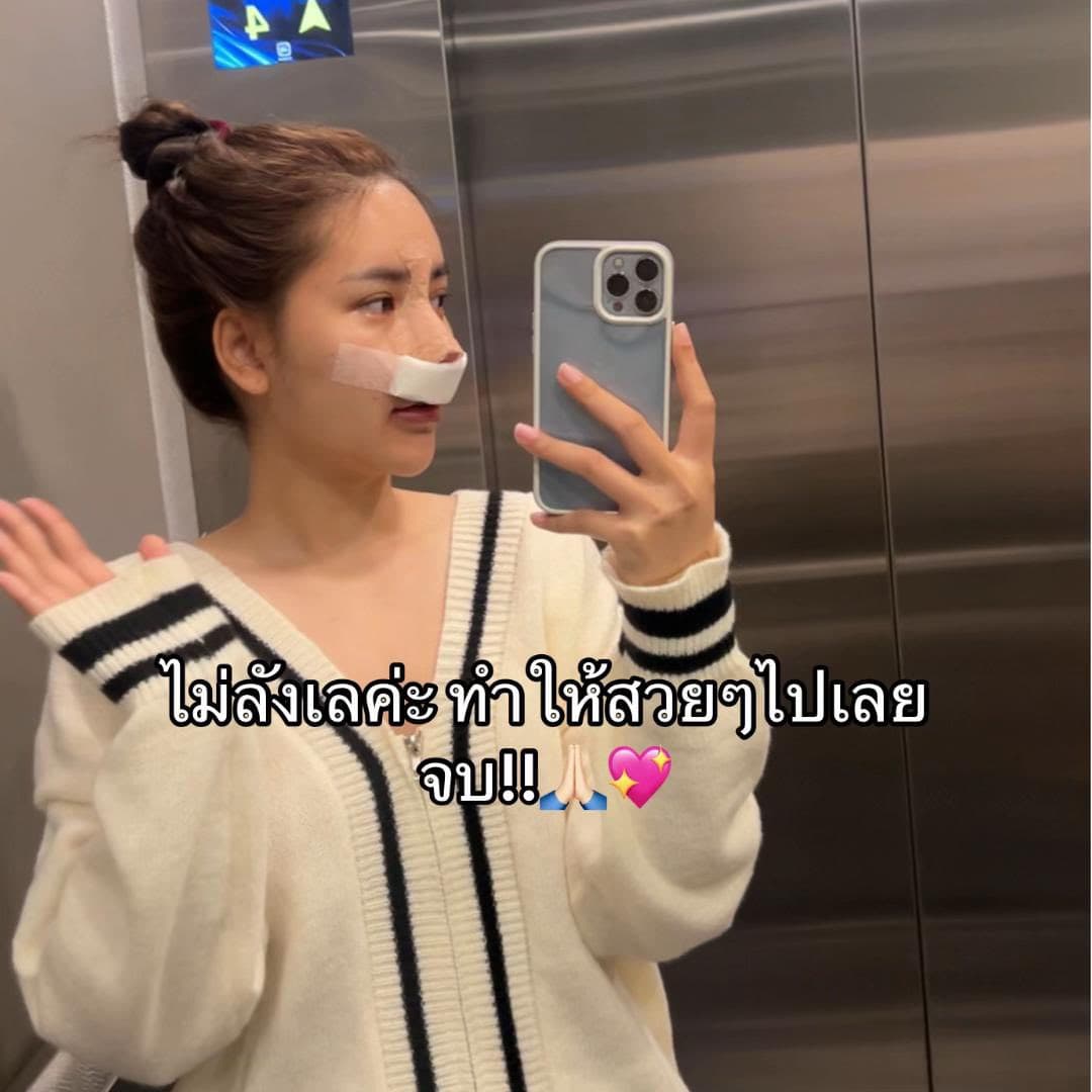 Balanced Nose Line ปรับรูจมูกให้ดูรับกับใบหน้ามากขึ้น 9 แก้จมูก หมอบิ๊ก s45 clinic