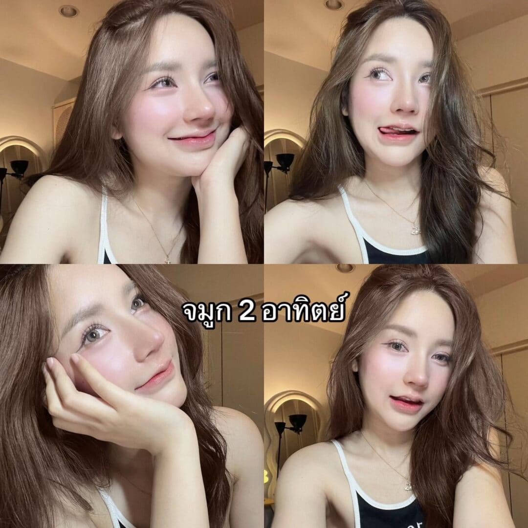 Balanced Nose Line ปรับรูจมูกให้ดูรับกับใบหน้ามากขึ้น 4 แก้จมูก หมอบิ๊ก s45 clinic