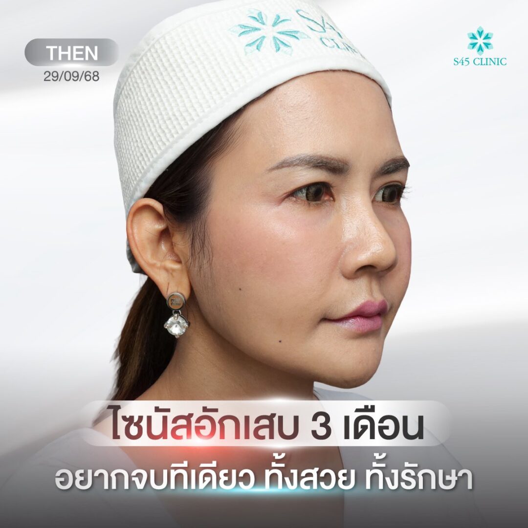 Too Perfect to Break ผลกระทบจากแก้จมูกบ่อย 11