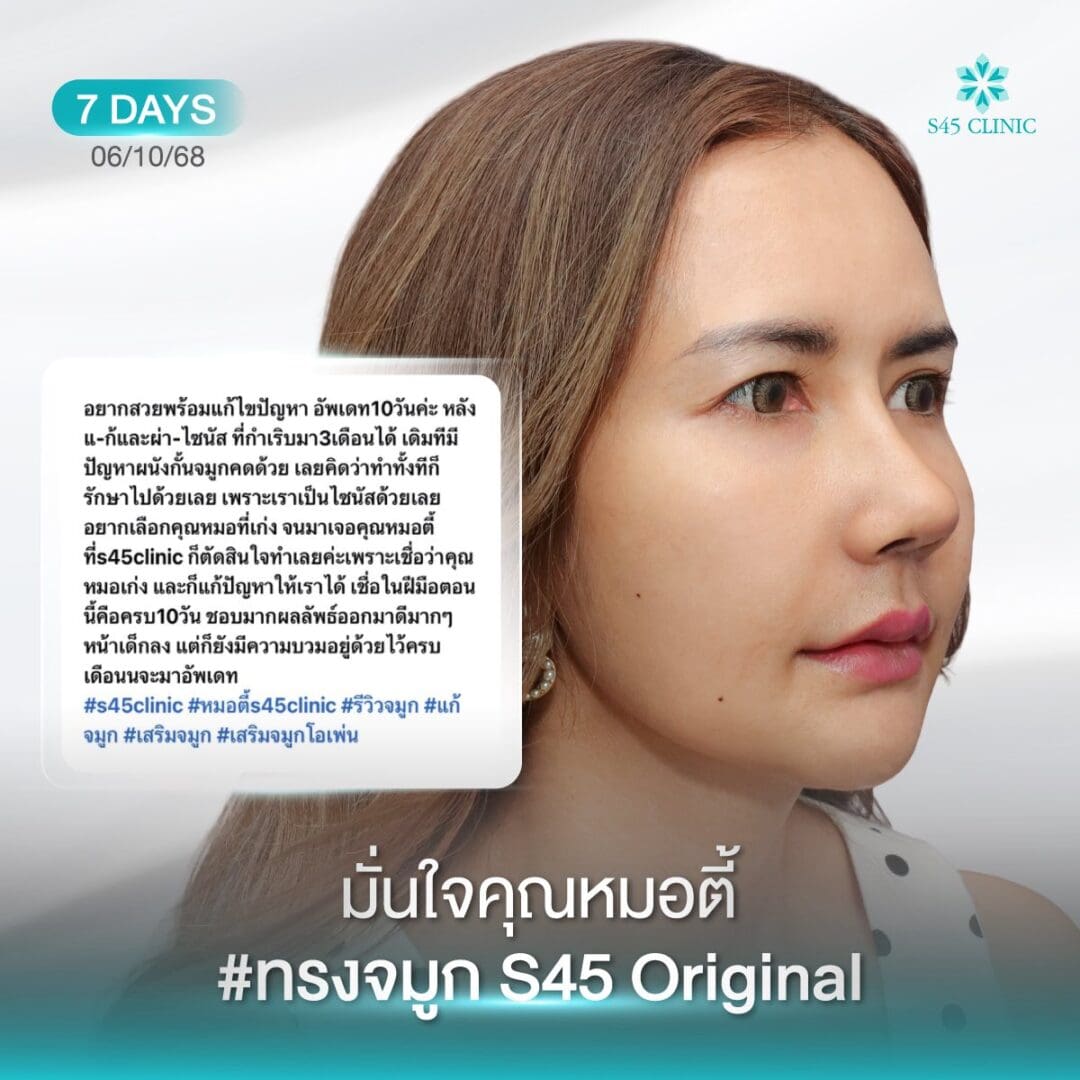 Too Perfect to Break ผลกระทบจากแก้จมูกบ่อย 12