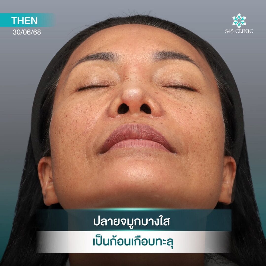 Too Perfect to Break ผลกระทบจากแก้จมูกบ่อย 6 แก้จมูก หมอตี้ S45 original