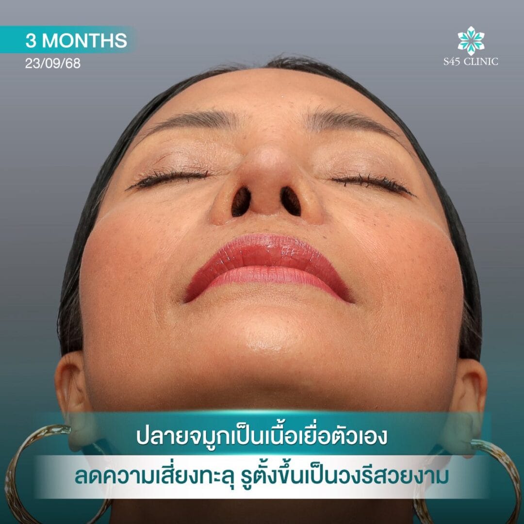 Too Perfect to Break ผลกระทบจากแก้จมูกบ่อย 8 แก้จมูก หมอตี้ S45 original