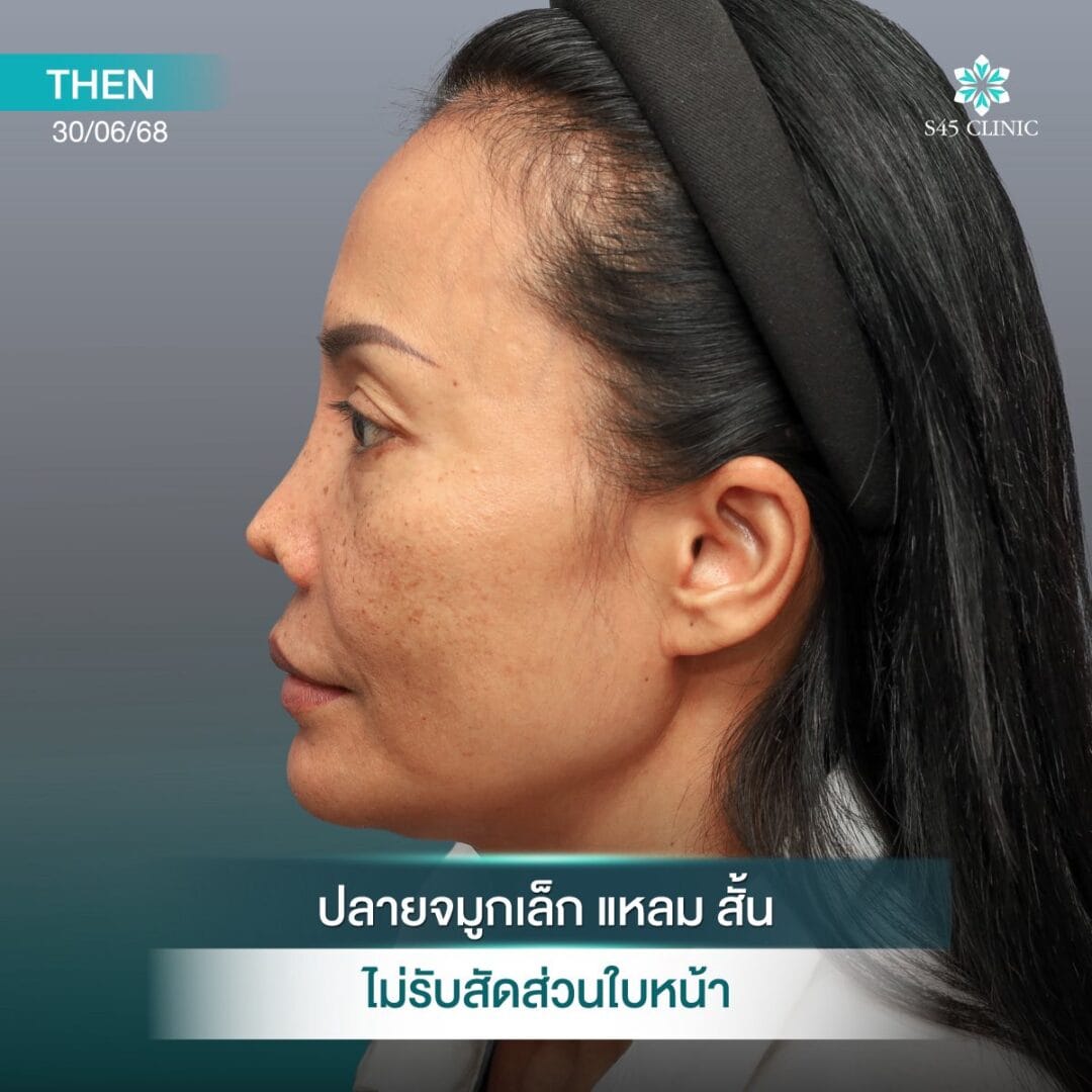 Too Perfect to Break ผลกระทบจากแก้จมูกบ่อย 7 แก้จมูก หมอตี้ S45 original