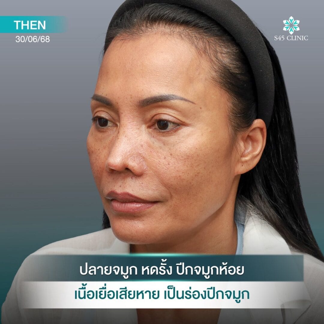 Too Perfect to Break ผลกระทบจากแก้จมูกบ่อย 5 แก้จมูก หมอตี้ S45 original