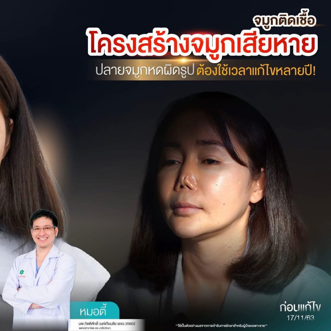 Nose Balance Check ไม่เคยศัลย์แต่จมูกเอียง 8 แก้จมูก หมอตี้ จมูกติดเชื้อ