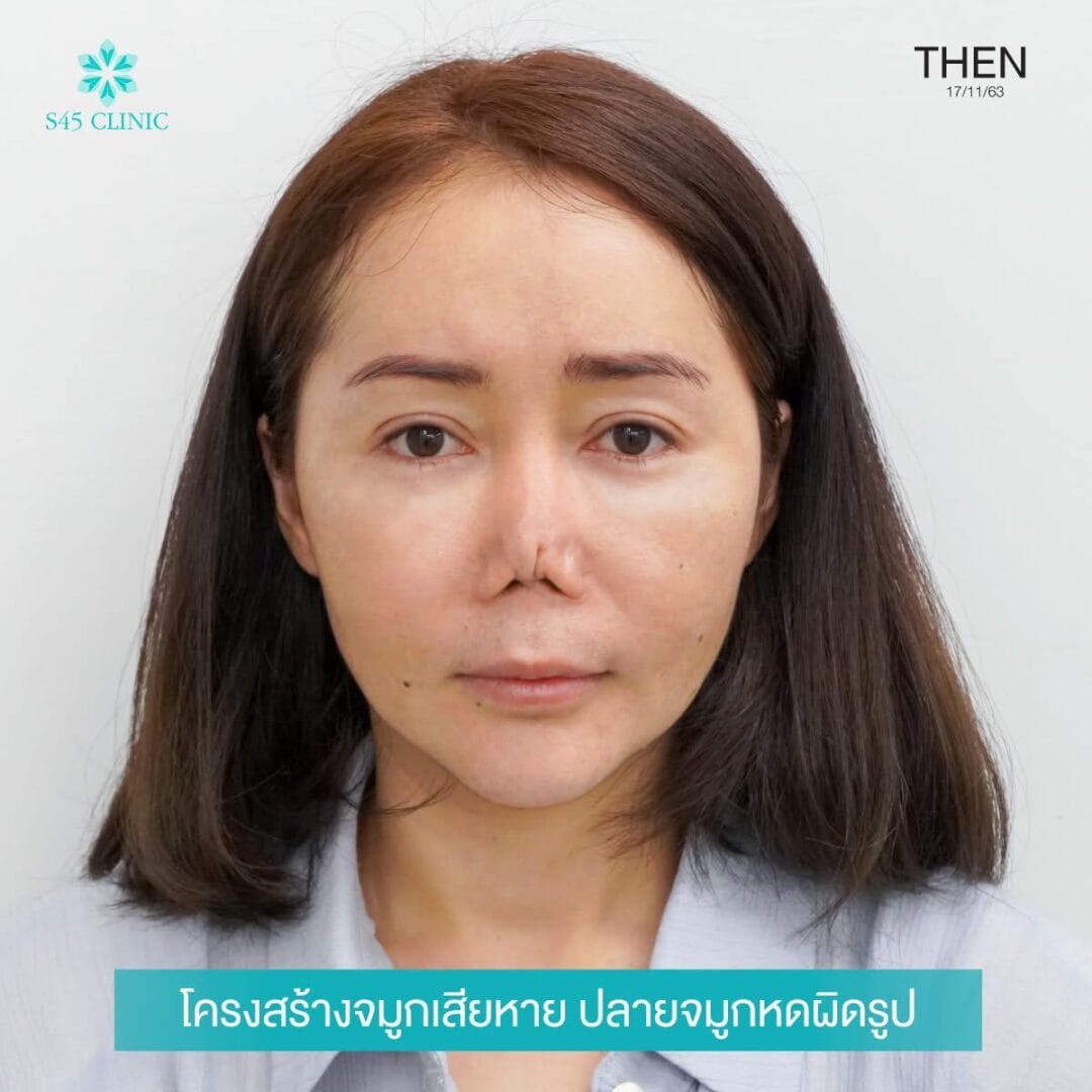 Nose Balance Check ไม่เคยศัลย์แต่จมูกเอียง 11 แก้จมูก หมอตี้ จมูกติดเชื้อ