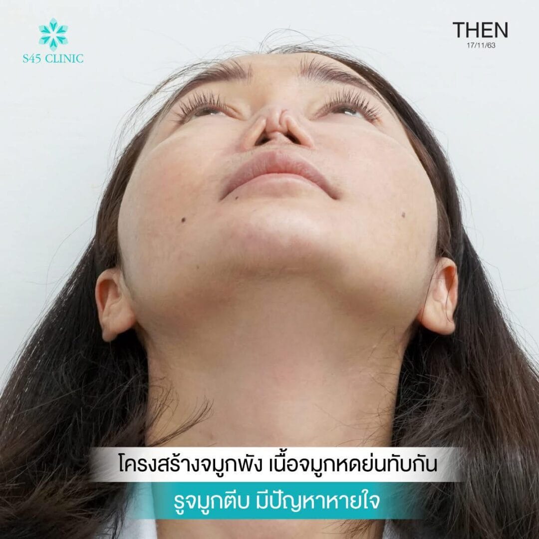 Balanced Nose Line ปรับรูจมูกให้ดูรับกับใบหน้ามากขึ้น 15 แก้จมูก หมอตี้ จมูกติดเชื้อ