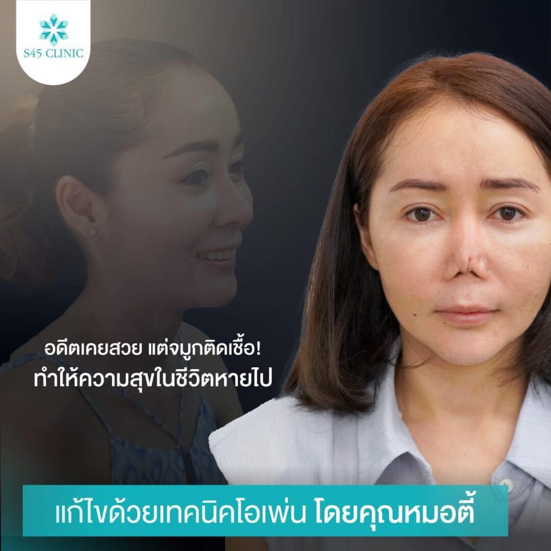 Nose Balance Check ไม่เคยศัลย์แต่จมูกเอียง 7 แก้จมูก หมอตี้ จมูกติดเชื้อ