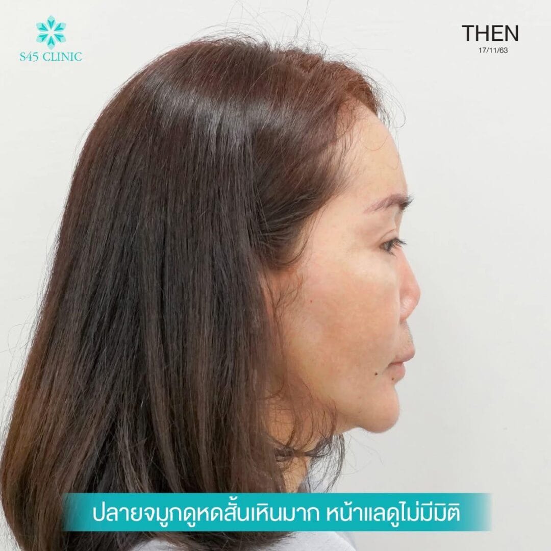 Nose Balance Check ไม่เคยศัลย์แต่จมูกเอียง 12 แก้จมูก หมอตี้ จมูกติดเชื้อ