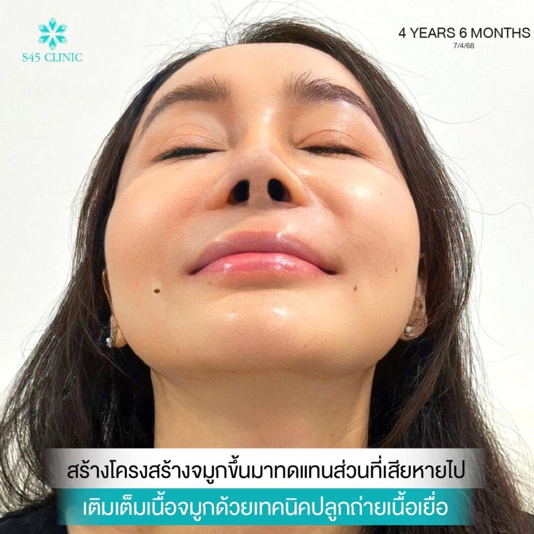 Balanced Nose Line ปรับรูจมูกให้ดูรับกับใบหน้ามากขึ้น 14 แก้จมูก หมอตี้ จมูกติดเชื้อ