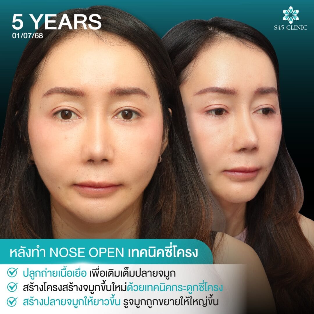 Nose Balance Check ไม่เคยศัลย์แต่จมูกเอียง 10 แก้จมูก หมอตี้ จมูกติดเชื้อ