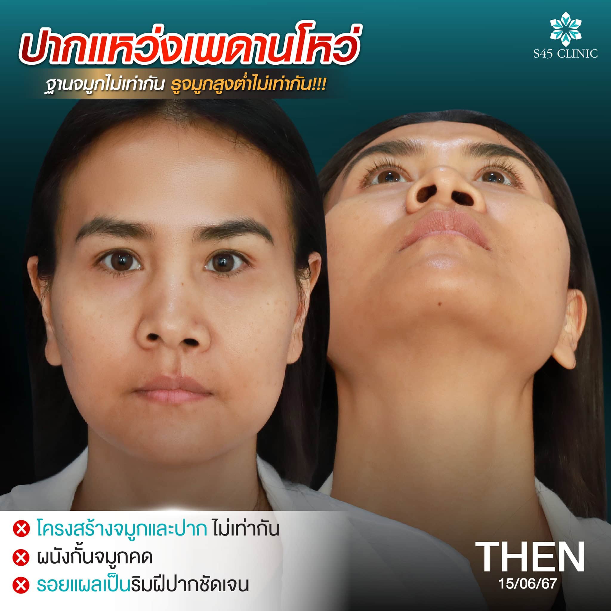 Restore & Refine รักษาปากแหว่งเพดานโหว่ก่อนเสริม 9 แก้จมูก หมอตี้ ปากแหว่งเพดานโหว่