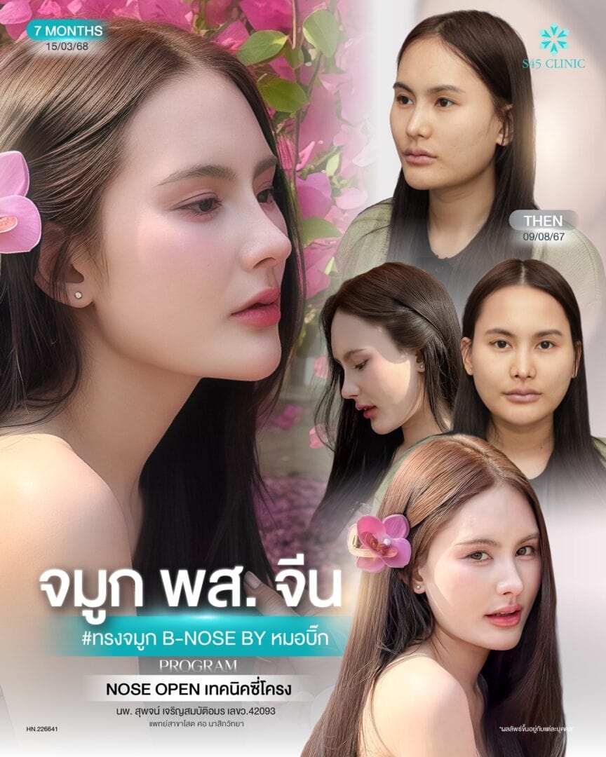 แก้จมูก หมอบิ๊ก