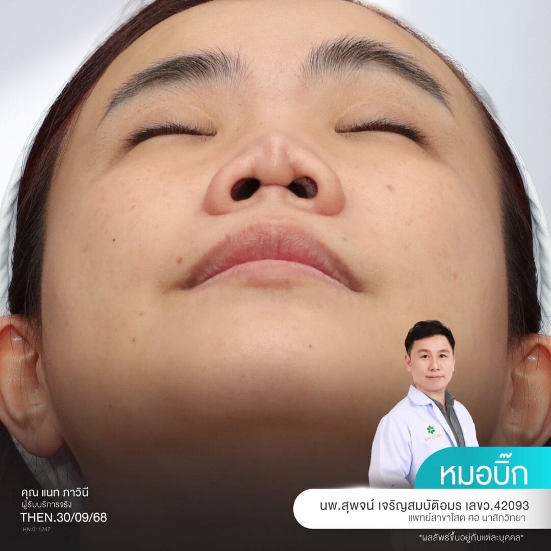 Balanced Nose Line ปรับรูจมูกให้ดูรับกับใบหน้ามากขึ้น 16 แก้จมูก หมอบิ๊ก