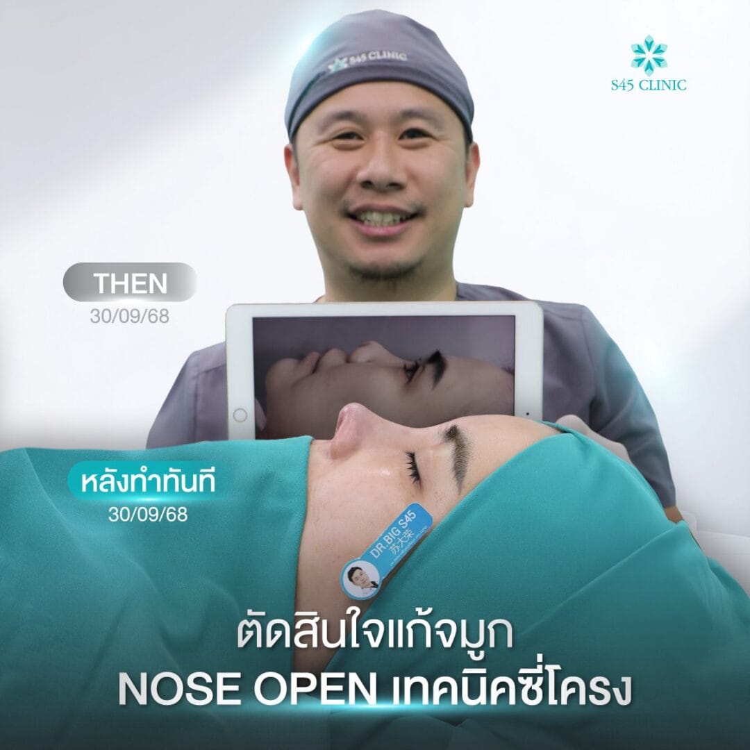 Nose Balance Check ไม่เคยศัลย์แต่จมูกเอียง 3 แก้จมูก หมอบิ๊ก
