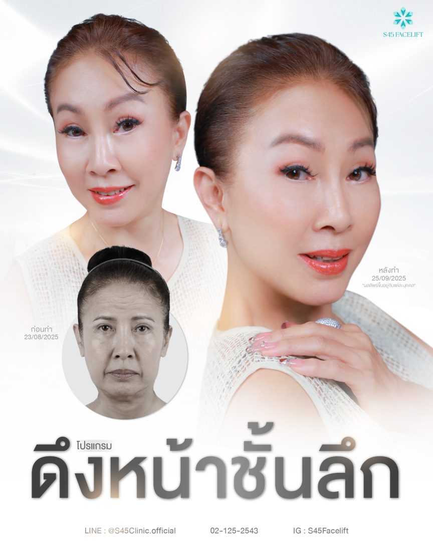 ยกคิ้วส่องกล้อง (Endoscopic Brow Lift) ราคา Friendly 7 ยกคิ้ว ส่องกล้อง ดึงหน้าชั้นลึก