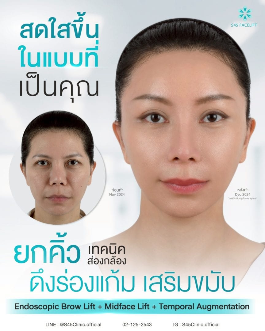 ยกคิ้ว ส่องกล้อง ดึงร่องแก้ม เสริมขมับ
