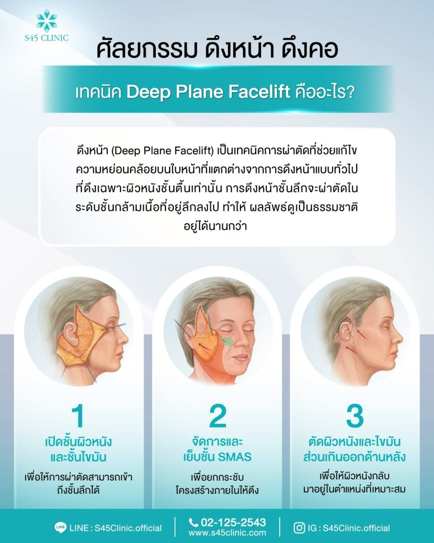 ยกคิ้ว ส่องกล้อง deep plane facelift