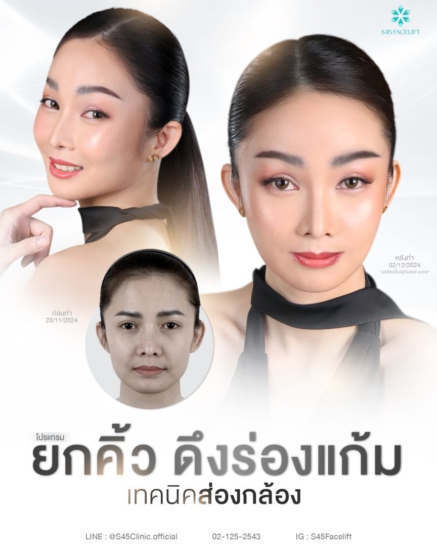 ยกคิ้วส่องกล้อง (Endoscopic Brow Lift) ราคา Friendly 8 ยกคิ้ว ส่องกล้อง ดึงร่องแก้ม