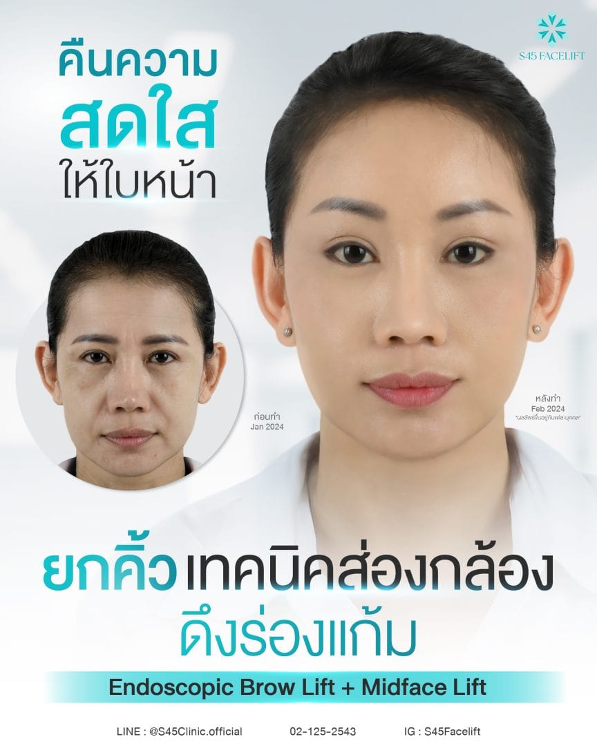 ยกคิ้ว ส่องกล้อง ดึงร่องแก้ม