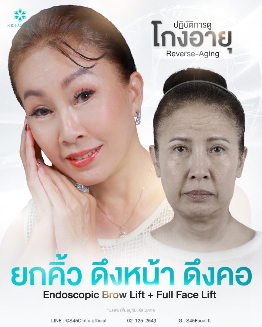 รวมเทคนิค ยกคิ้ว ส่องกล้อง (Endoscopic Brow Lift) S45 Clinic 22 ยกคิ้ว ส่องกล้อง ดึงหน้า ดึงคอ