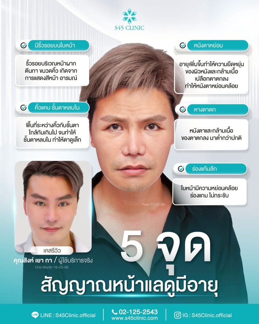 5 จุด ยกคิ้ว ส่องกล้อง