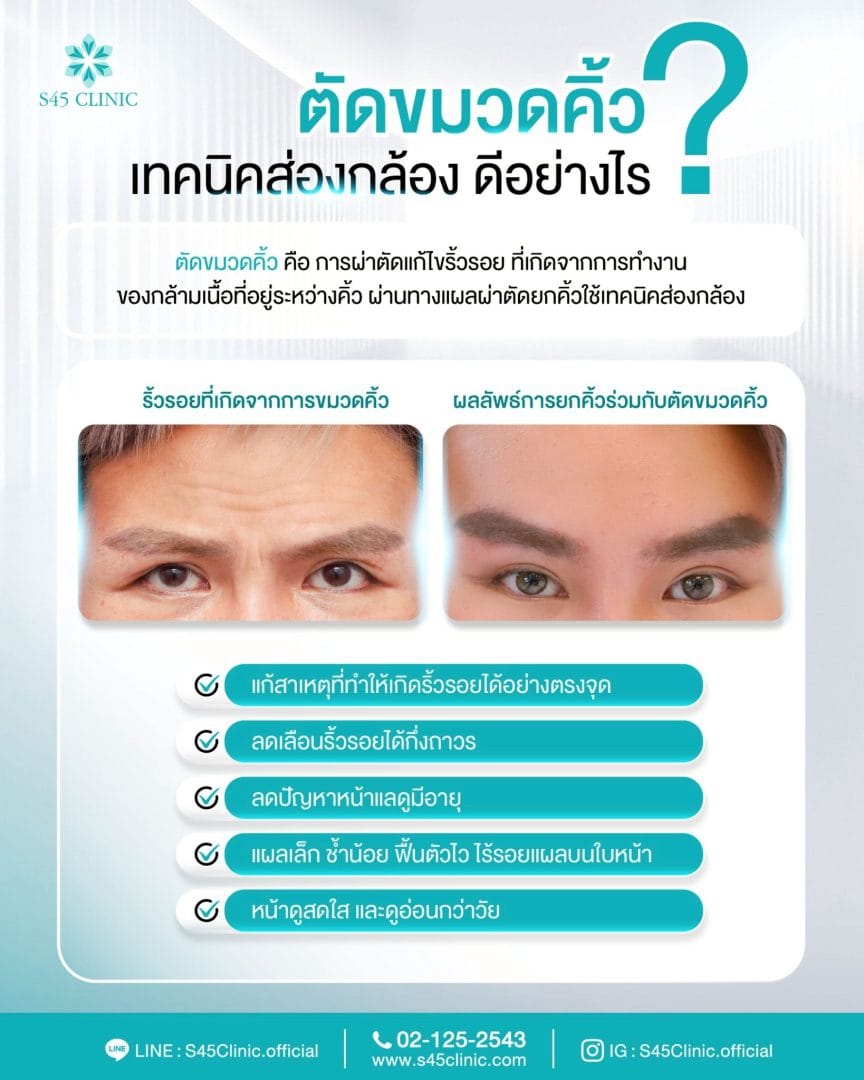 ยกคิ้วส่องกล้อง (Endoscopic Brow Lift) ราคา Friendly 5 ตัดขมวดคิ้ว ยกคิ้ว ส่องกล้อง