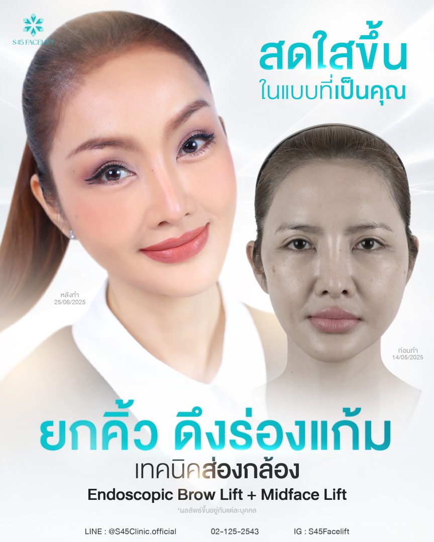 ยกคิ้ว ส่องกล้อง ดึงร่องแก้ม