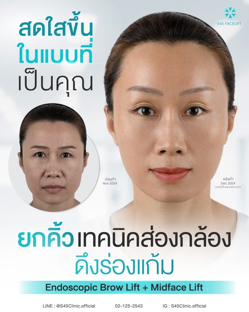 รวมเทคนิค ยกคิ้ว ส่องกล้อง (Endoscopic Brow Lift) S45 Clinic 19 ยกคิ้ว ส่องกล้อง ดึงร่องแก้ม