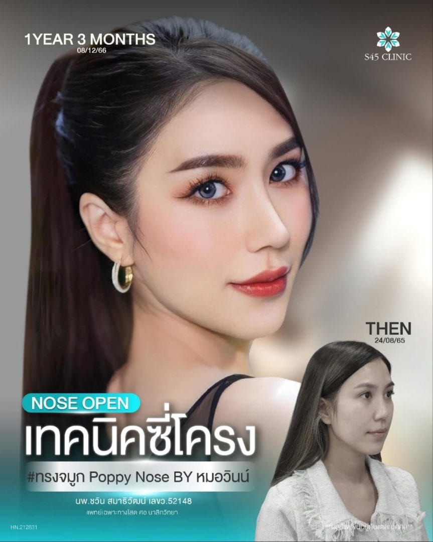 เสริมจมูก เทคนิคซี่โครง