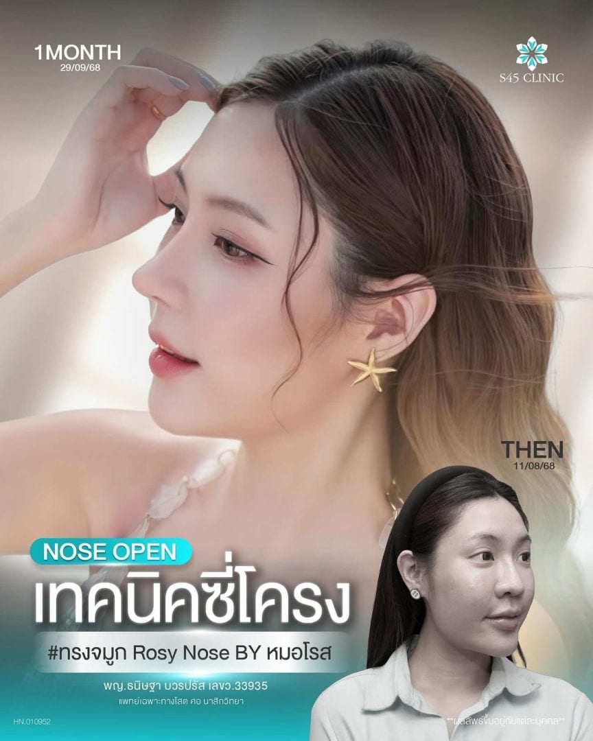 เสริมจมูก เทคนิคซี่โครง