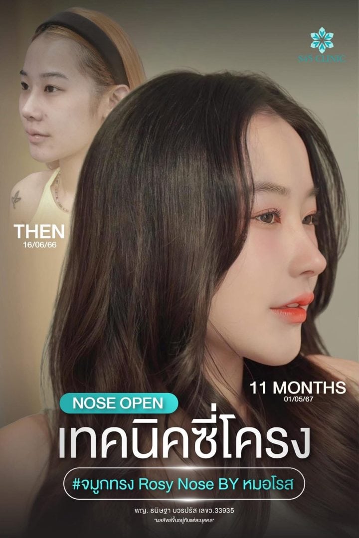 เสริมจมูก เทคนิคซี่โครง