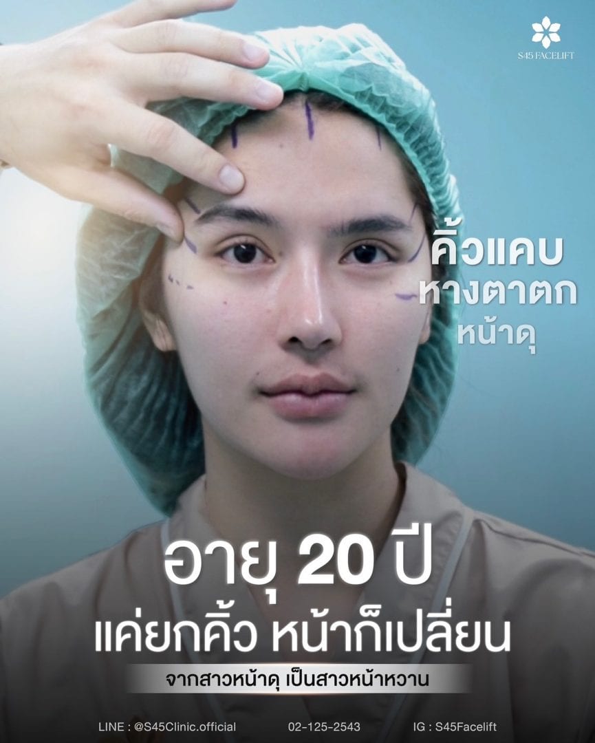อายุแค่ 25 หน้าแก่กว่าเพื่อนร่วมรุ่น ต้องยกคิ้ว ส่องกล้องไหม 2 ยกคิ้ว ส่องกล้อง