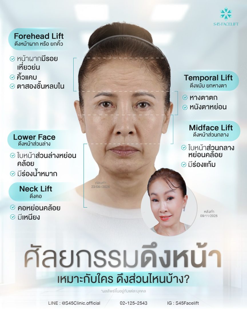 ยกคิ้วส่องกล้อง (Endoscopic Brow Lift) ราคา Friendly 4 ยกคิ้ว ส่องกล้อง