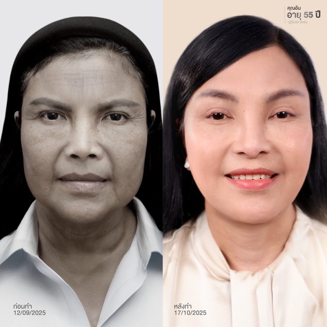 รวมเทคนิค ยกคิ้ว ส่องกล้อง (Endoscopic Brow Lift) S45 Clinic 7 ยกคิ้ว ส่องกล้อง