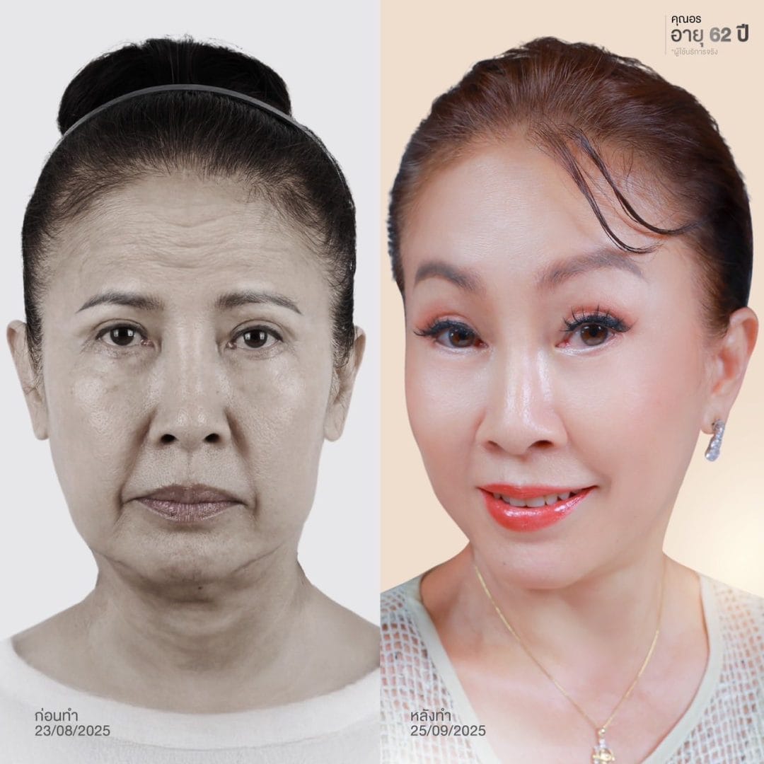 รวมเทคนิค ยกคิ้ว ส่องกล้อง (Endoscopic Brow Lift) S45 Clinic 6 ยกคิ้ว ส่องกล้อง