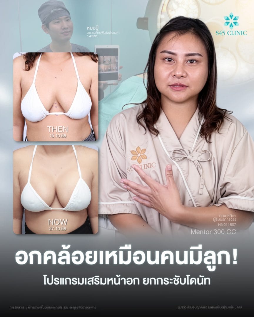 เหตุผลที่ต้องแก้ทรงหน้าอก หลังจากเสริมหน้าอกมา 10 ปี 4 เสริมหน้าอก S45 Clinic