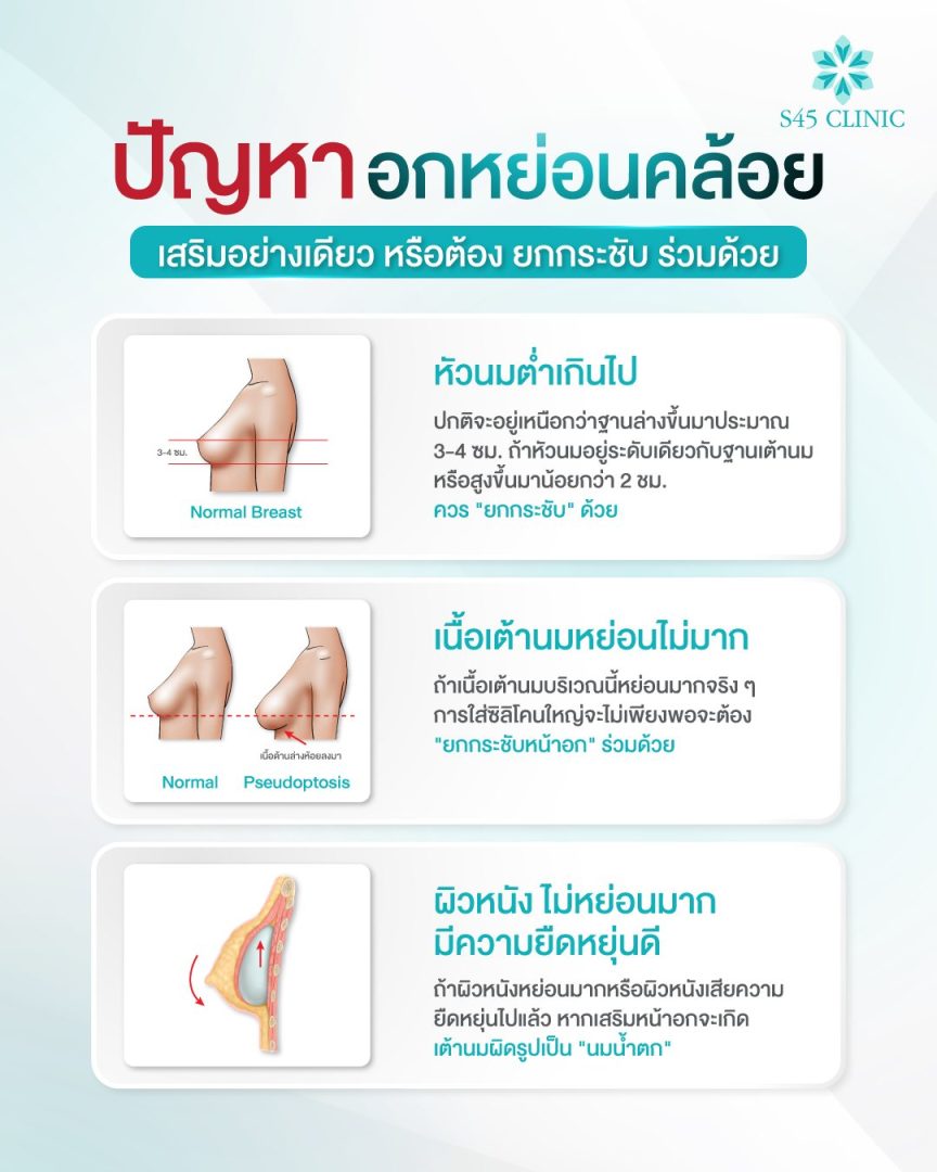 เหตุผลที่ต้องแก้ทรงหน้าอก หลังจากเสริมหน้าอกมา 10 ปี 2 เสริมหน้าอก S45 Clinic