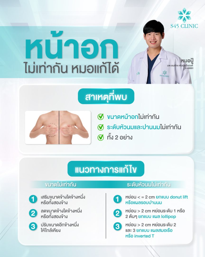 เหตุผลที่ต้องแก้ทรงหน้าอก หลังจากเสริมหน้าอกมา 10 ปี 5 เสริมหน้าอก S45 Clinic