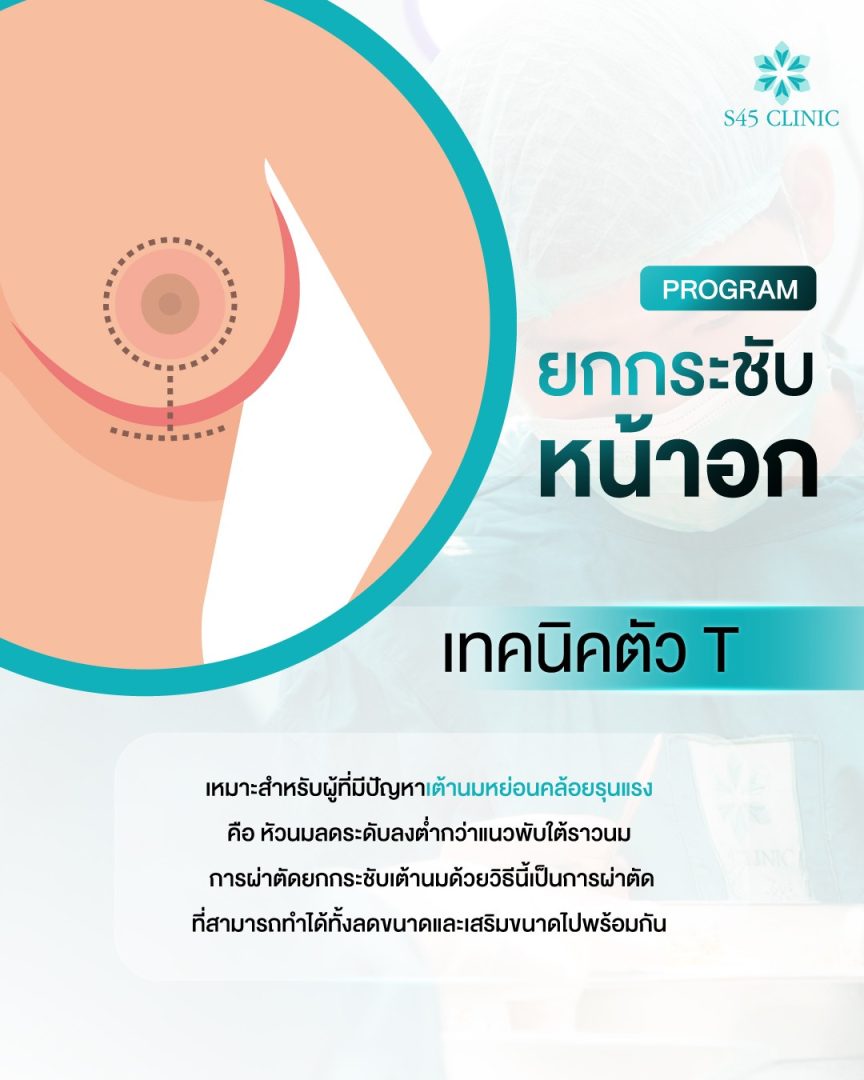 เหตุผลที่ต้องแก้ทรงหน้าอก หลังจากเสริมหน้าอกมา 10 ปี 3 เสริมหน้าอก ตัว T