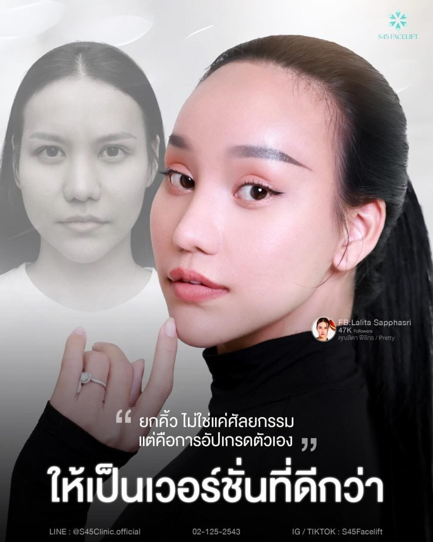 Endofict คืออะไร ทำไมใช้ในการ ยกคิ้ว ส่องกล้อง 3 ยกคิ้ว ส่องกล้อง