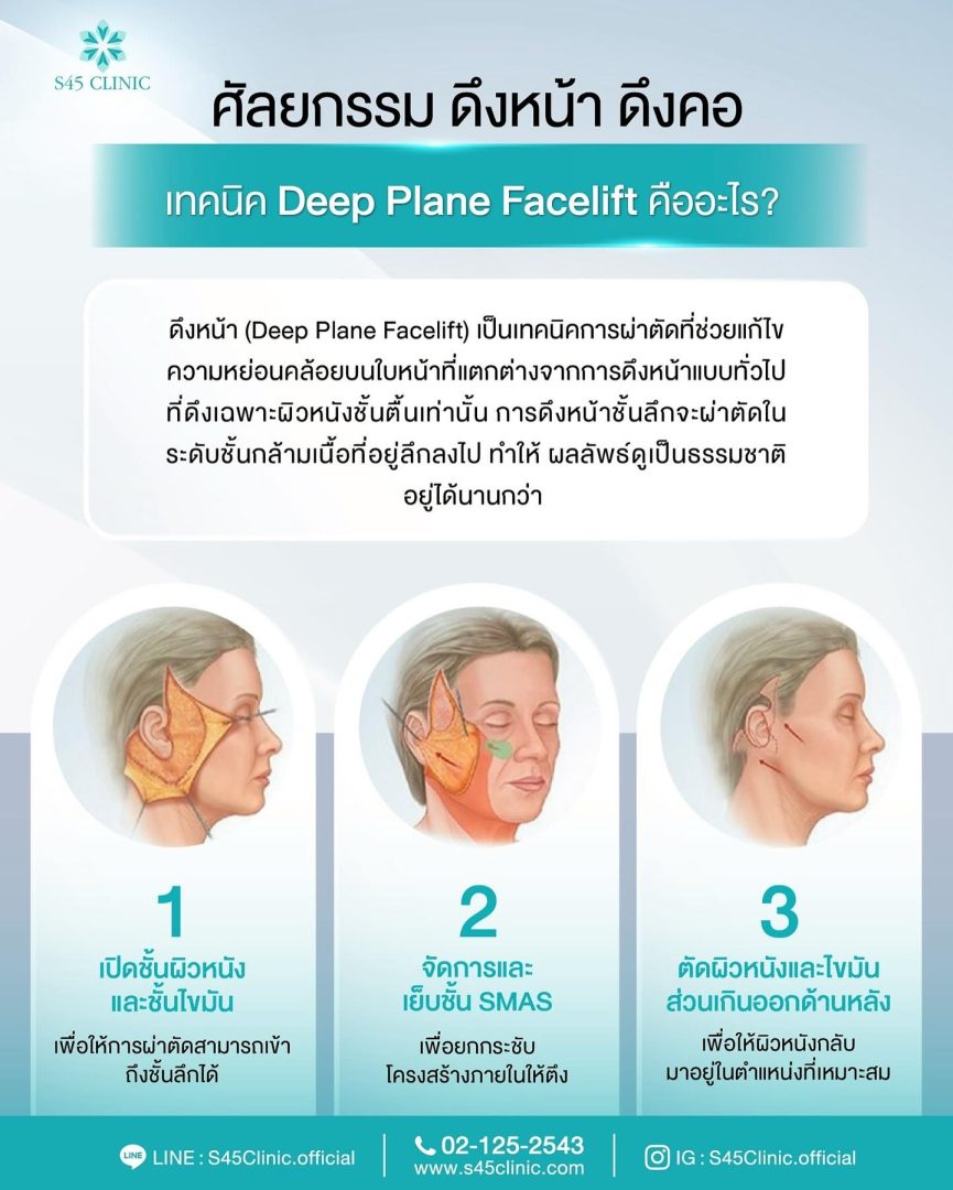 deep plane facelift