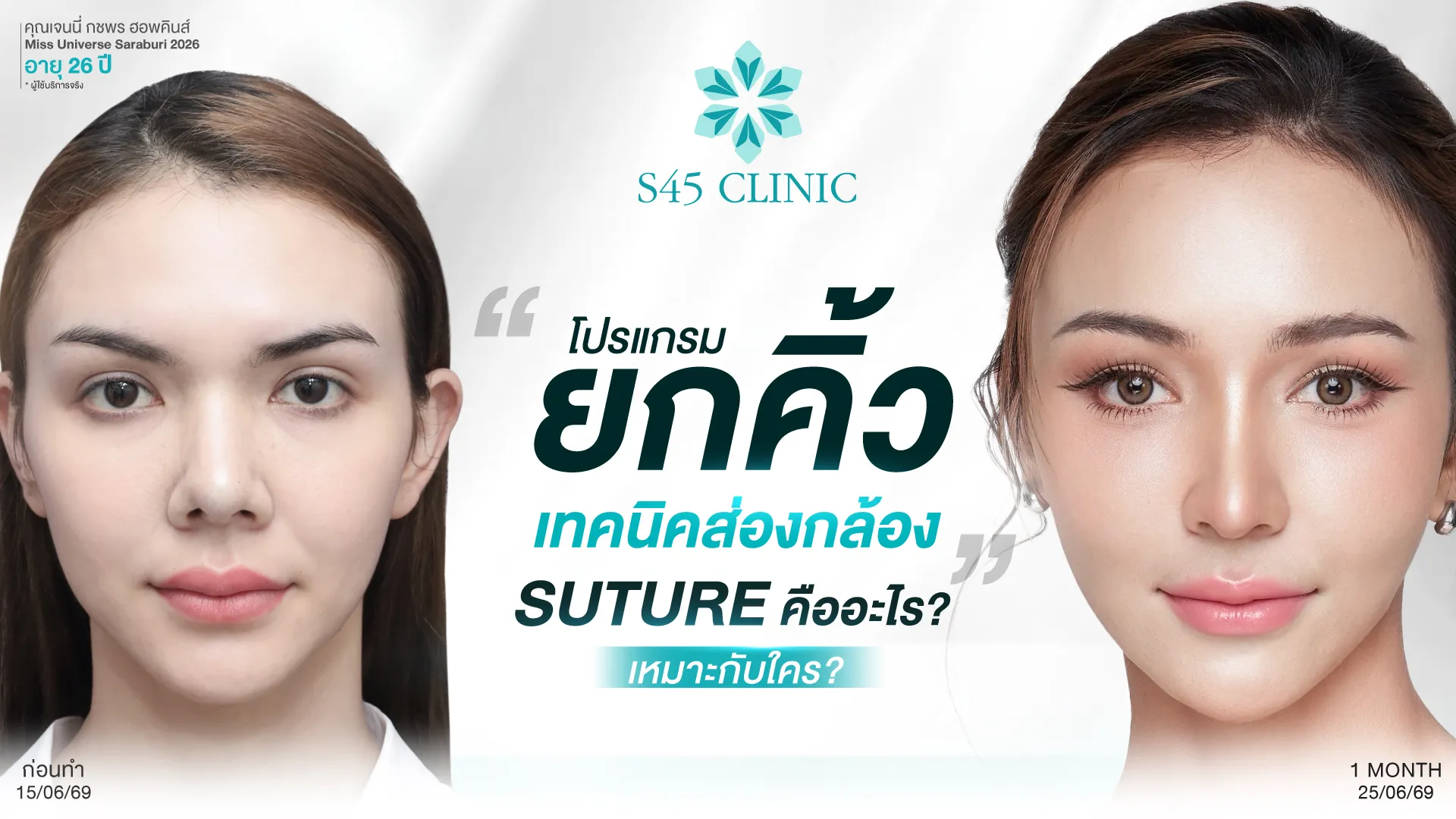 ยกคิ้ว Suture สำหรับเว็ป S45 Clinic
