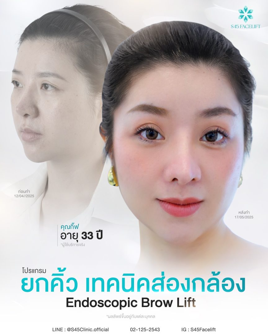 ยกคิ้ว ส่องกล้อง