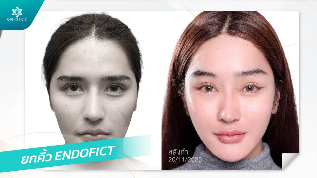 ยกคิ้ว ส่องกล้อง