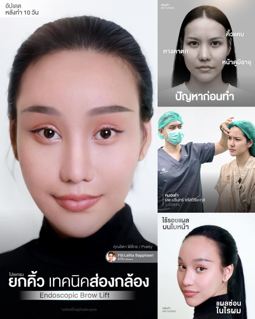 หน้าแก่ชราแต่กำเนิด (cutis laxa) ยกคิ้ว ส่องกล้อง ได้ไหม 3 ยกคิ้ว ส่องกล้อง