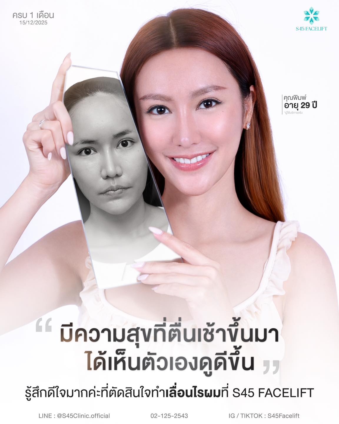 เลื่อนไรผม