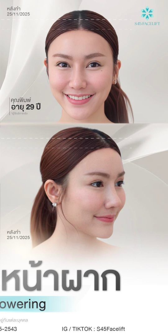 เลื่อนไรผม