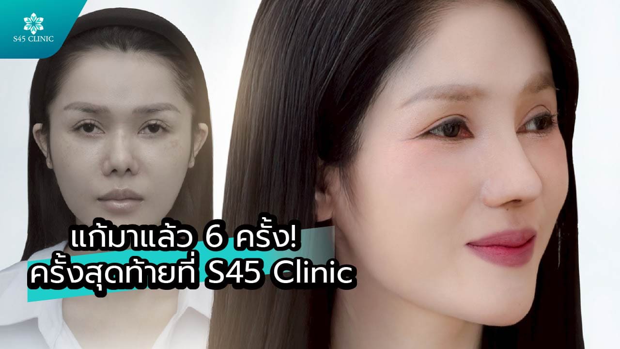 แก้จมูก